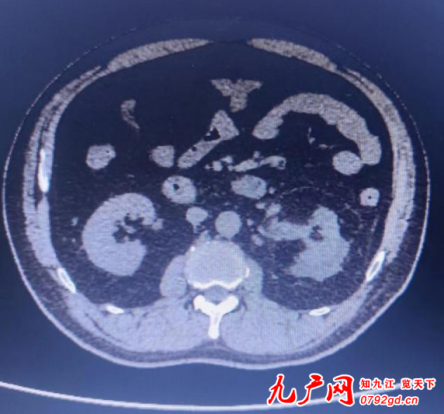 九江市第一人民医院泌尿外科完成两例复杂腹腔镜手术